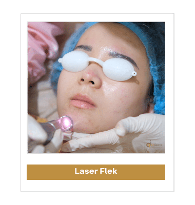 Treatment Laser Flek